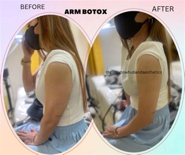 Barbie-like Arms Without Surgery: The Ultimate Guide To Barbie Arm Botox