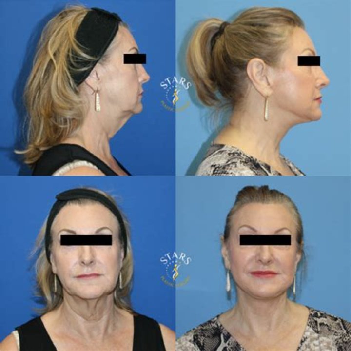 Botched Neck Lift: Avoidable Mistakes And Precautionary Measures