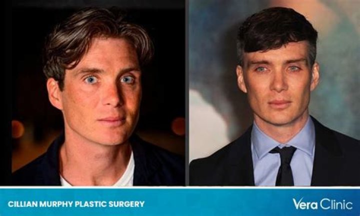 Cillian Murphy Nose: Did He Underwent Surgery? Before And After Pics