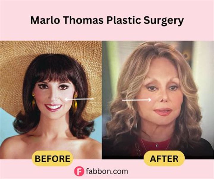 Unveiling The Truth: Marlo Thomas's Rhinoplasty Journey
