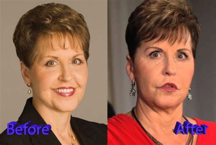 Unveiling The Truths Behind Joyce Meyer's Plastic Surgery Journey