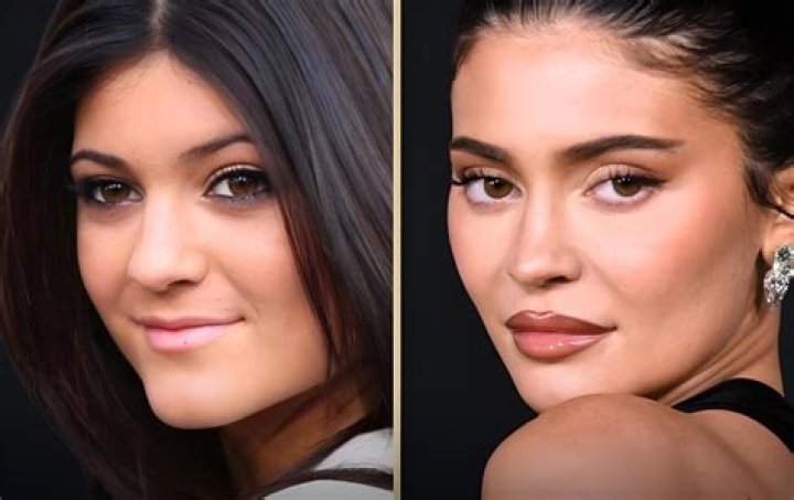 The Truth About Kylie Jenner Lip Challenge: Risks And Remedies Revealed
