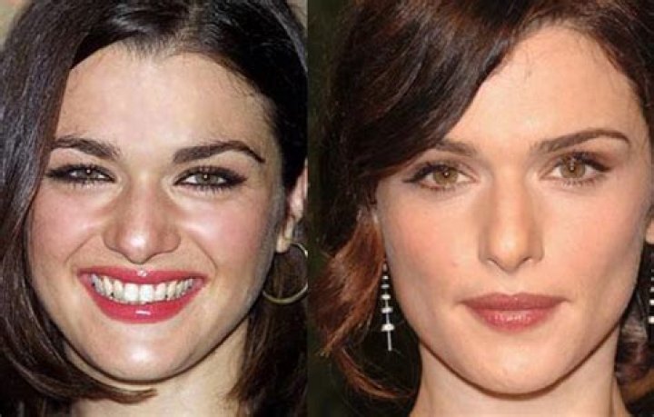 Rachel Weisz Facelift Plastic Surgery Before and After ·