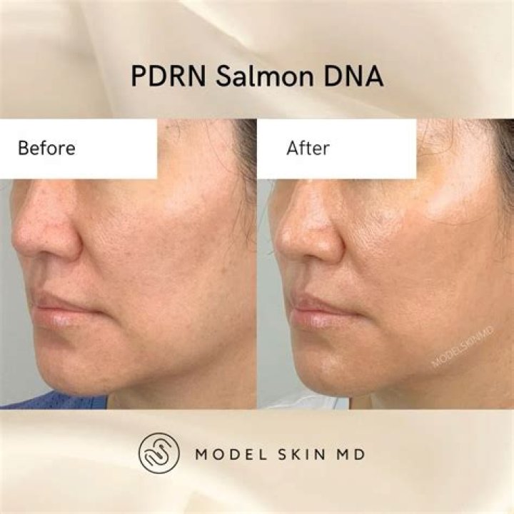 Revolutionary Salmon DNA Microneedling: Unlocking Youthful Radiance