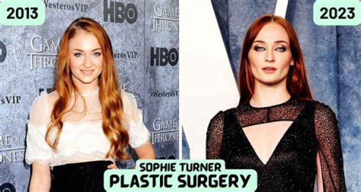 Sophie Turner Before Cosmetic Enhancements