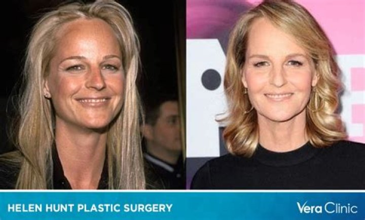 What Happened to Helen Hunt’s Face? The Truth Behind the Plastic Surgery Rumors